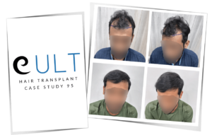 Hair transplant Case 95 before and after - Dr Gaurav Solanki hair transplant results Gurgaon