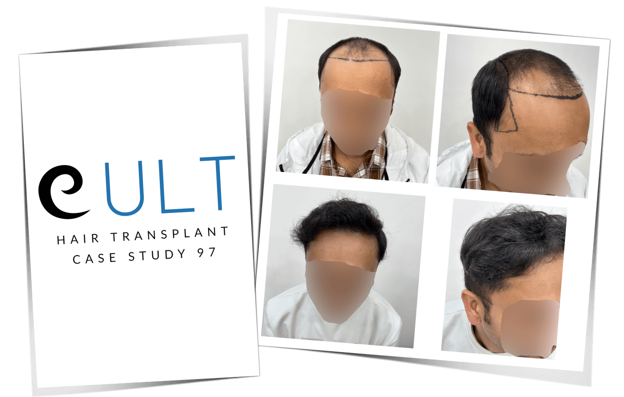 Hair Transplant Case Study 97 | Cult Aesthetics