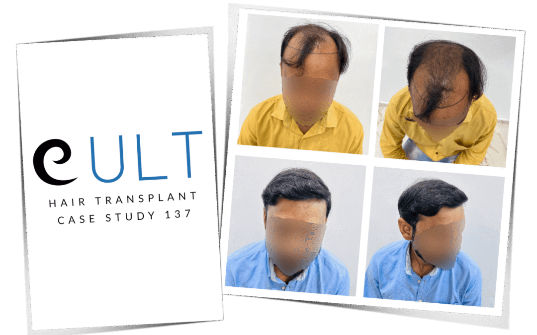 Hair Transplant Case Study 137 1