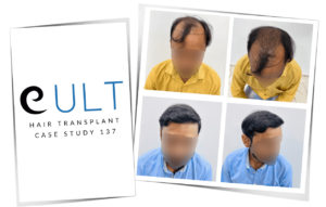 Hair transplant Case 137 before and after photo - Cult Aesthetics best clinic Gurgaon