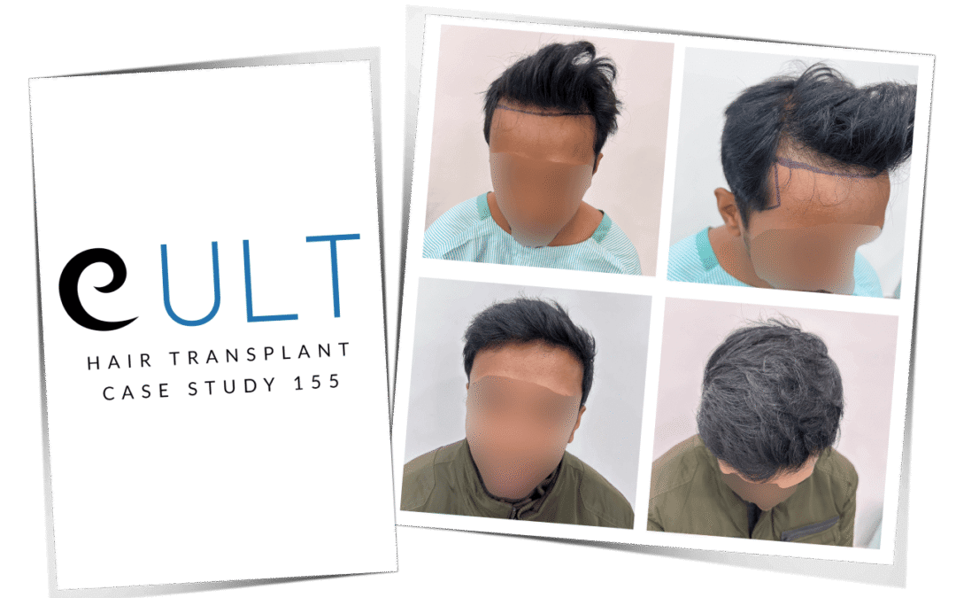 Hair Transplant Case Study 155 1