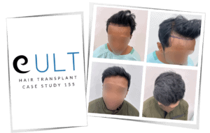 Hair restoration Case 155 before after results - Best hair transplant surgeon in Gurgaon Dr Gaurav
