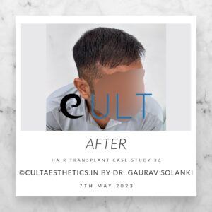 Long Term Update Case 36 3 - Hair Transplant Clinic in Gurgaon