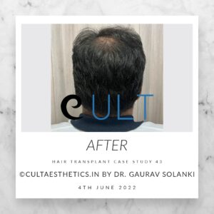 Long Term Update Case 43 2 - Hair Transplant Clinic in Gurgaon