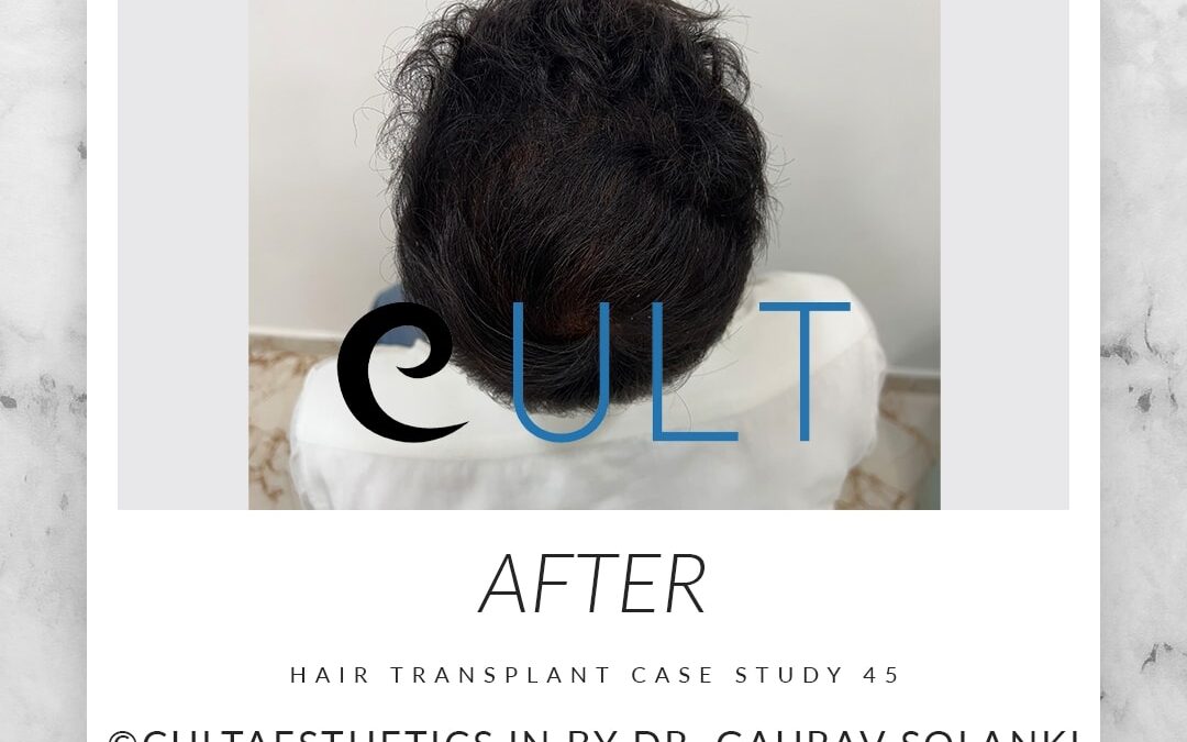 Long Term Update Case 45 1