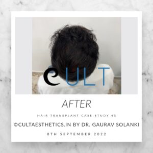 Long Term Update Case 45 1 - Hair Transplant Clinic in Gurgaon