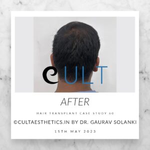 Long Term Update Case 60 2 - Hair Transplant Clinic in Gurgaon
