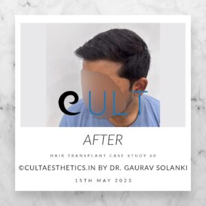 Long Term Update Case 60 4 - Hair Transplant Clinic in Gurgaon