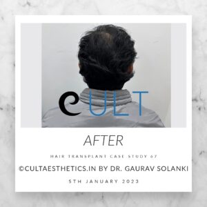 Long Term Update Case 67 2 - Hair Transplant Clinic in Gurgaon