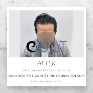 Long Term Update Case 67 4 - Hair Transplant Clinic in Gurgaon