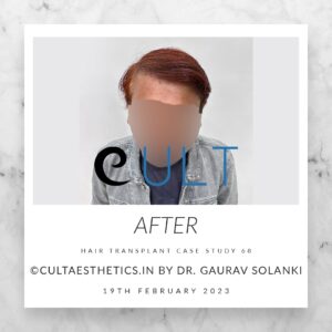 Long Term Update Case 68 6 - Hair Transplant Clinic in Gurgaon