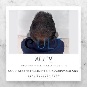 Long Term Update Case 69 1 - Hair Transplant Clinic in Gurgaon