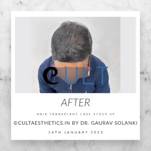 Long Term Update Case 69 3 - Hair Transplant Clinic in Gurgaon