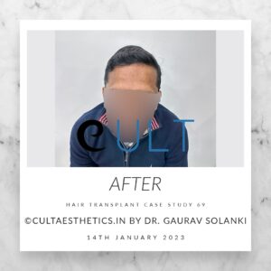 Long Term Update Case 69 4 - Hair Transplant Clinic in Gurgaon