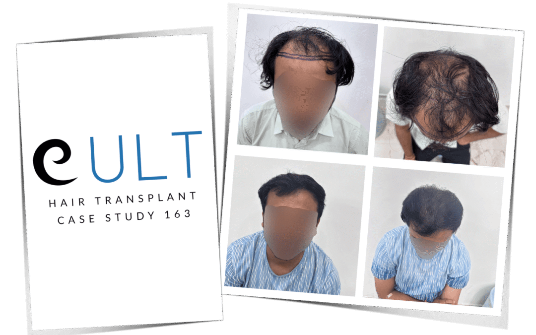 Hair Transplant Case Study 163 1
