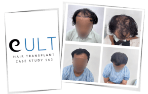 FUE hair transplant Case 163 before and after - Dr Gaurav Solanki Cult Aesthetics Gurgaon