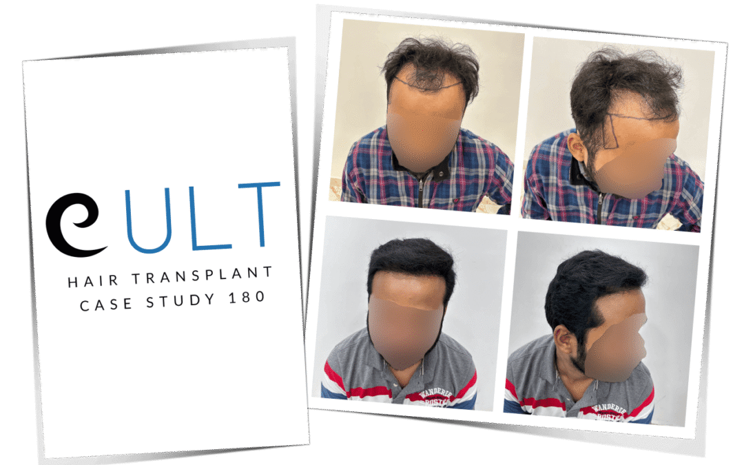 Hair Transplant Case Study 180 1
