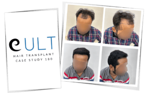 Hair transplant result Case 180 - Before and after by Dr Gaurav Solanki best hair transplant Gurgaon