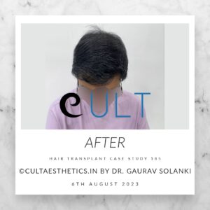 Hair Transplant Case 185 - After Results at Cult Aesthetics Gurgaon