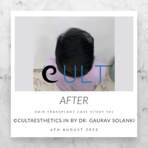 Hair Transplant Case 185 - After Results at Cult Aesthetics Gurgaon