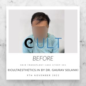 Hair Transplant Case 185 - Before Treatment at Cult Aesthetics Gurgaon