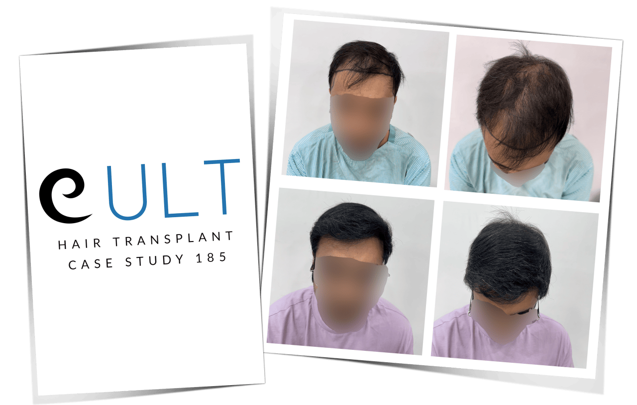 Hair Transplant Case Study 64
