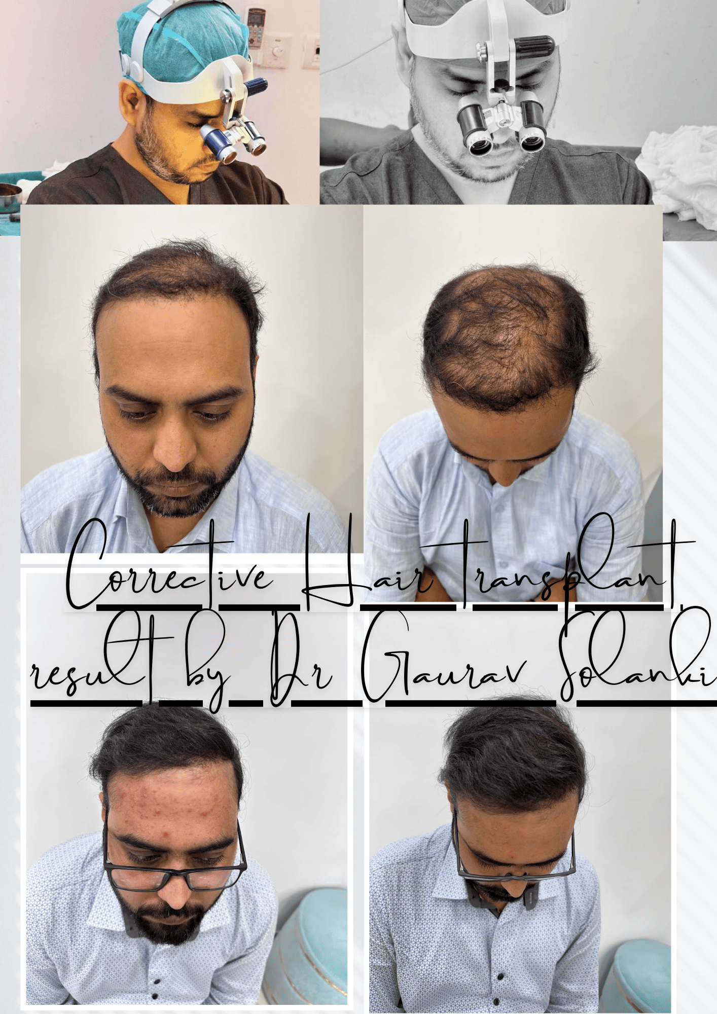 Hair transplant correction of two times failed hair transplant done By Dr. Gaurav Solanki (before and after) .