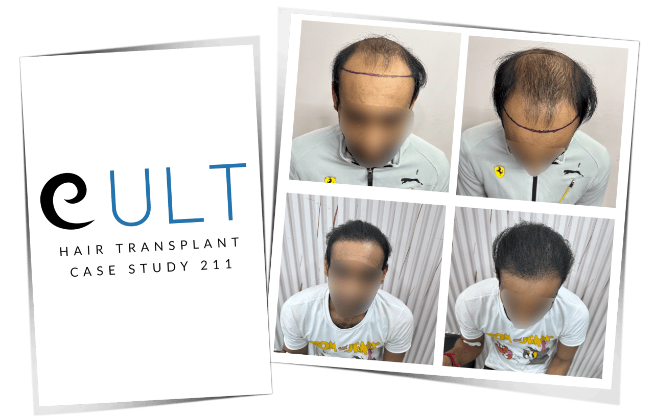 Hair Transplant Case Study 58