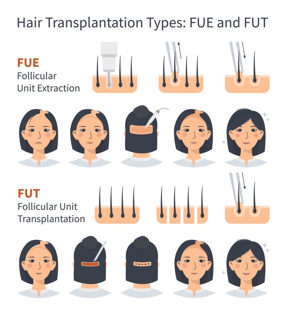 FUE and FUT female hair transplant methods illustrated