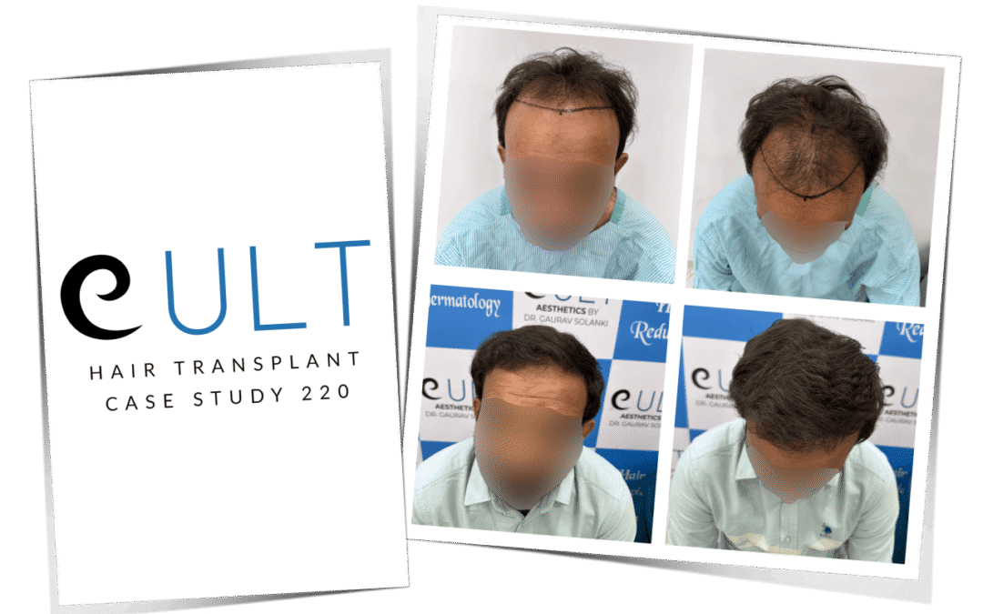 Hair Transplant Case Study 220 1