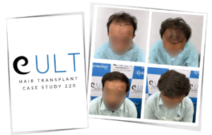 Hair transplant before and after Case 220 - Best results in Gurgaon by Dr Gaurav Solanki Cult Aesthetics
