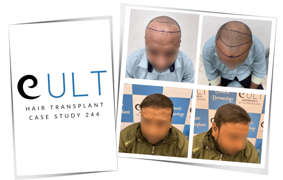 Grade 3 & Grade 4 Hair Transplant Results Cult Aesthetics