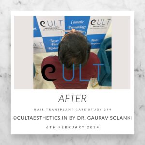 Hair Transplant Case 249 - After Results at Cult Aesthetics Gurgaon