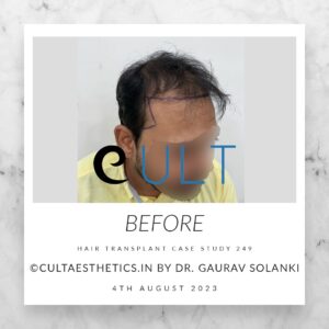 Hair Transplant Case 249 - Before Treatment at Cult Aesthetics Gurgaon