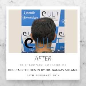 Hair Transplant Case 250 - After Results at Cult Aesthetics Gurgaon