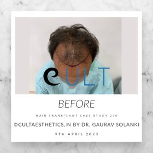 Hair Transplant Case 250 - Before Treatment at Cult Aesthetics Gurgaon