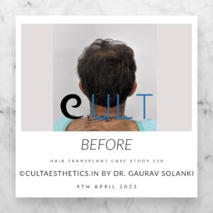 Hair Transplant Case 250 - Before Treatment at Cult Aesthetics Gurgaon