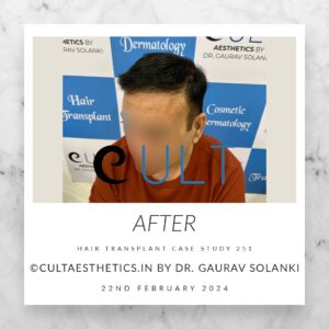 Hair Transplant Case 251 - After Results at Cult Aesthetics Gurgaon
