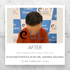 Hair Transplant Case 251 - After Results at Cult Aesthetics Gurgaon