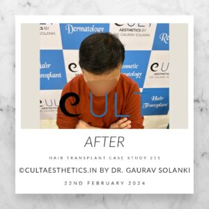 Hair Transplant Case 251 - After Results at Cult Aesthetics Gurgaon