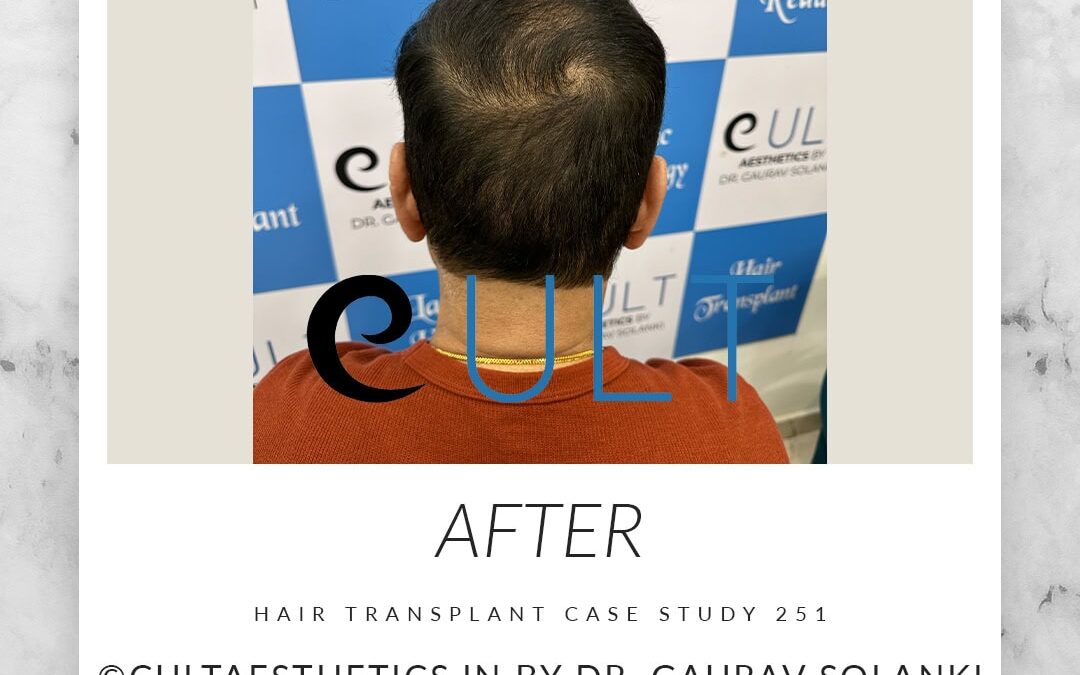 Case 251 After 4