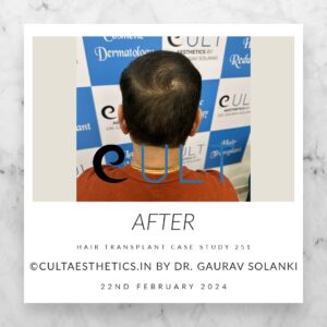Hair Transplant Case 251 - After Results at Cult Aesthetics Gurgaon