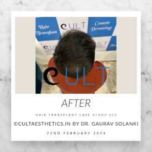 Hair Transplant Case 251 - After Results at Cult Aesthetics Gurgaon