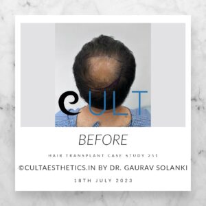 Hair Transplant Case 251 - Before Treatment at Cult Aesthetics Gurgaon