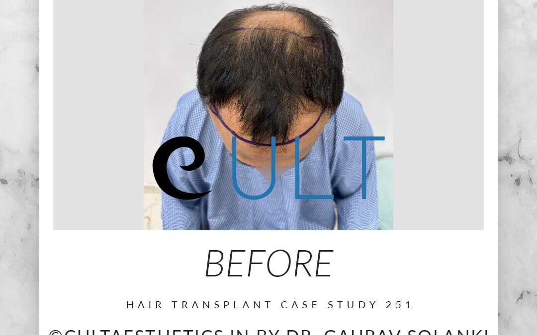 Case 251 Before 4