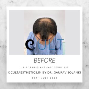 Hair Transplant Case 251 - Before Treatment at Cult Aesthetics Gurgaon