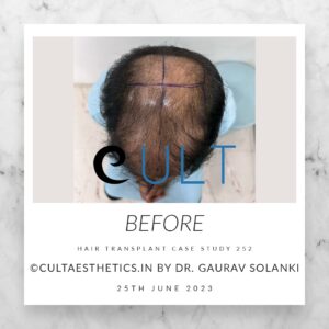 Hair Transplant Case 252 - Before Treatment at Cult Aesthetics Gurgaon