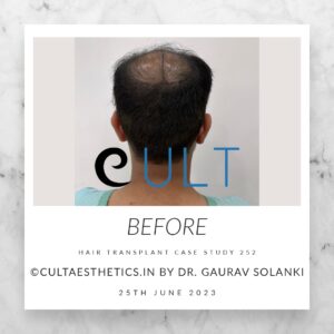 Hair Transplant Case 252 - Before Treatment at Cult Aesthetics Gurgaon