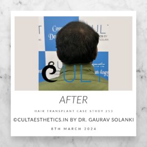 Hair Transplant Case 253 - After Results at Cult Aesthetics Gurgaon