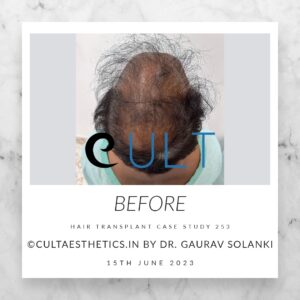 Hair Transplant Case 253 - Before Treatment at Cult Aesthetics Gurgaon